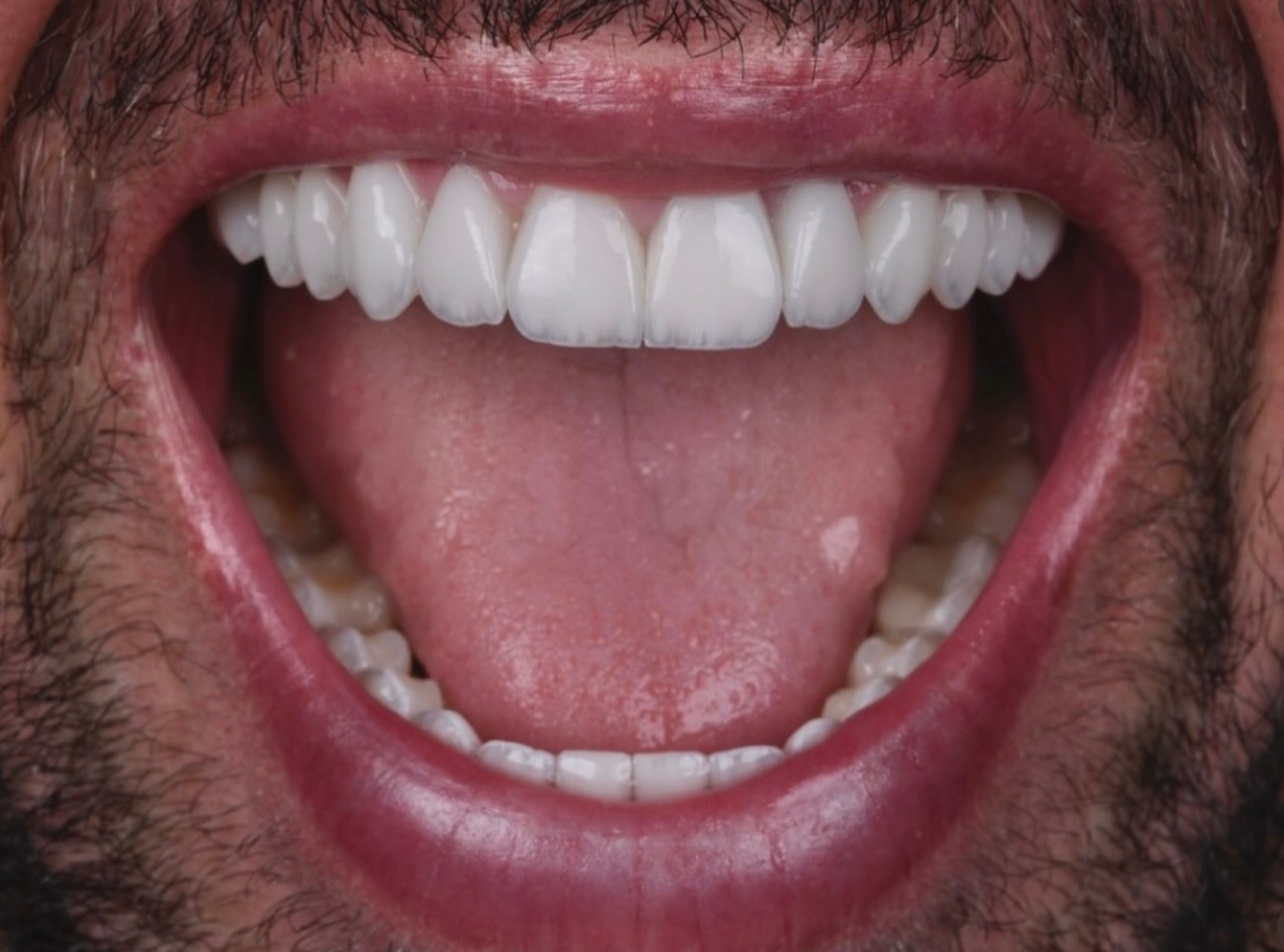 Detalhe de sorriso finalizado em lentes de contato de resina